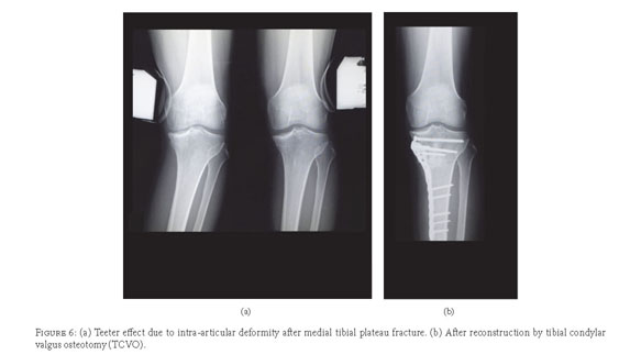 Intra And Extra Articular Deformity Of Lower Limb Tibial Condylar