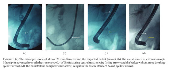 Gale Onefile Health And Medicine Document Impacted And Fractured Biliary Basket A Second Basket Rescue Technique