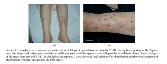 Granulomatous diseases of the breast and axilla: radiological findings with  pathological correlation, Insights into Imaging