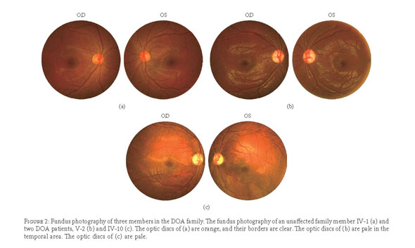 An 18-year-old man with dominant optic atrophy (DOA). The fundus