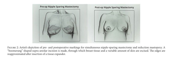 One year post-op and first post here! Nipple-sparing double incision. :  r/TopSurgery