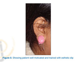 Pressure Earring as an Adjunct to Surgical Removal of Earlobe Keloids -  SAVION - 2009 - Dermatologic Surgery - Wiley Online Library