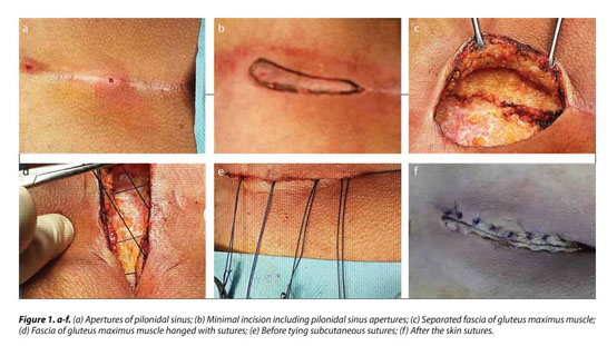 Excision of Extensive Recurrent Pilonidal Cyst with Gluteus Muscle Fascia  Plasty & Mid-line Closure 
