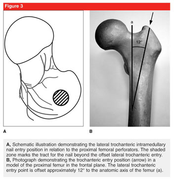 Intramedullary nailing of pediatric femoral shaft fracture - Document -  Gale Academic OneFile