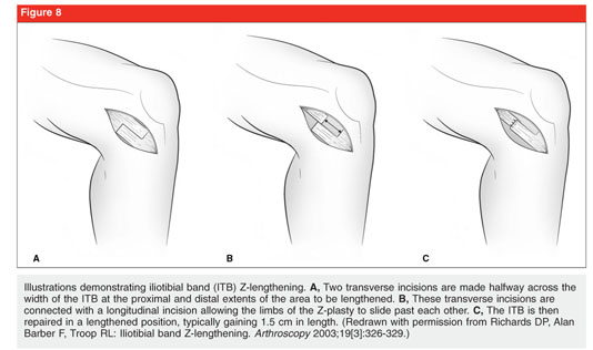 Iliotibial band syndrome: evaluation and management - Document