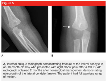 fishtail deformity lateral condyle fracture