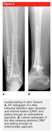 Ilizarov method of fixation for the management of pilon and distal tibial  fractures in the compromised diabetic patient: A technique guide.