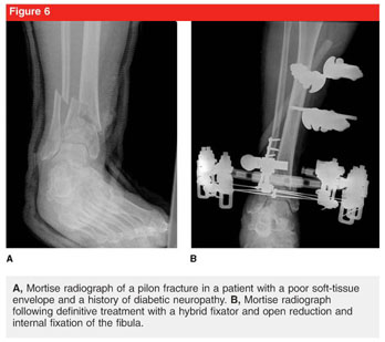 Ilizarov method of fixation for the management of pilon and distal tibial  fractures in the compromised diabetic patient: A technique guide.