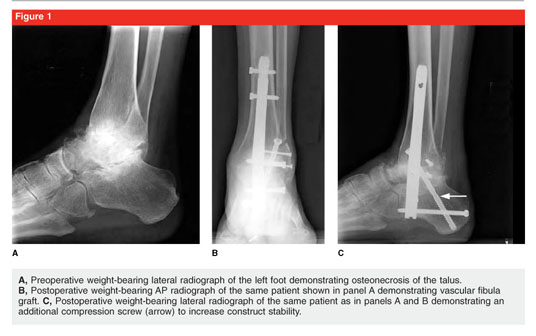 The use of intramedullary nails in tibiotalocalcaneal arthrodesis -  Document - Gale OneFile: Health and Medicine