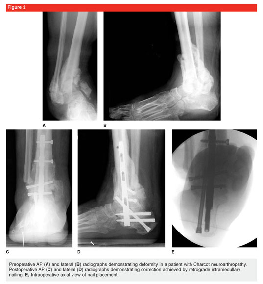 The use of intramedullary nails in tibiotalocalcaneal arthrodesis -  Document - Gale OneFile: Health and Medicine