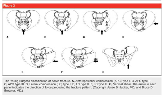 What are the different types of pelvic fracture?