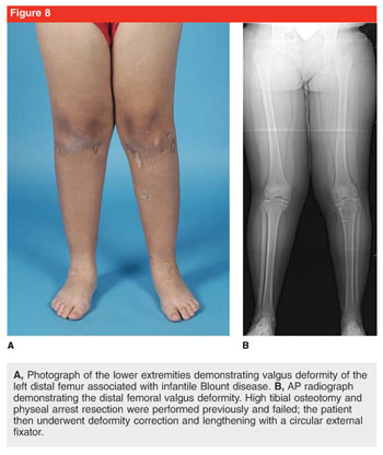 PDF] Tibia vara or Blount's disease: Why an early diagnosis and