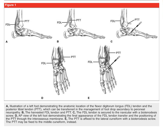 hoke procedure foot