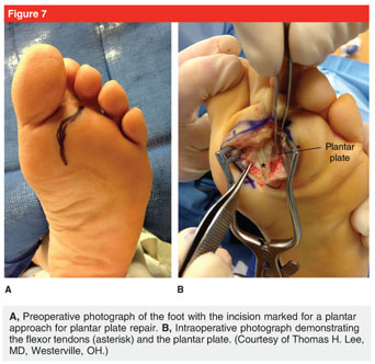 Dorsomedial Approach to MTP Joint of Great Toe - Approaches
