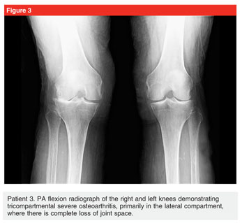 Medial collateral ligament sprain rehabilitation exercises - Document -  Gale OneFile: Health and Medicine