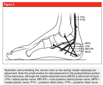 Fixation of ring fixator to proximal tibia. (a) Transverse wire