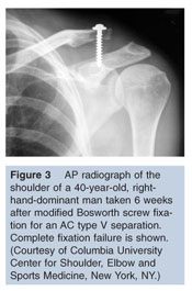 AC Joint Separation Salem, OR  Shoulder Joint Separation