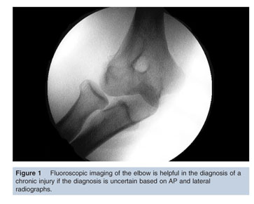 Medial collateral ligament sprain rehabilitation exercises - Document -  Gale OneFile: Health and Medicine