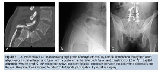 Spondylolisthesis in Athletes: Treatment and Return to Sports