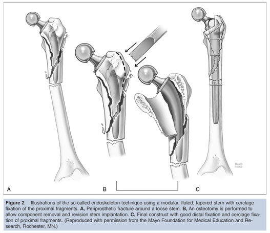 29 Revision For Periprosthetic Fractures Of The Hip And Knee Document Gale Onefile Health