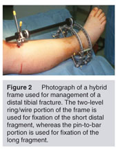 Ring external fixator (definitive) for Complete articular fracture,  fragmentary articular
