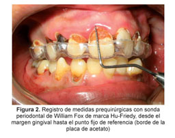 Gale Academic Onefile Document Variaciones Del Margen Gingival Despues De Alargamiento De Corona Clinica Reporte A 6 Meses