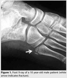 Foot X-ray of a 10 year-old male patient (white arrow indicates