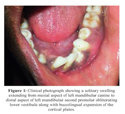 Clinical photograph showing the swelling in the mandibu