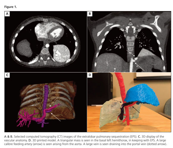 3d Display Of An Extralobar Pulmonary Sequestration With Unusual Drainage Into The Portal Venous System Image En 3d D Une Sequestration Pulmonaire Extralobaire Avec Drainage Atypique Dans La Veine Porte Document Gale