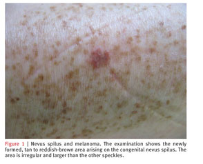 congenital nevus melanoma