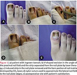 A comparison of effectiveness and cosmetic outcome of two methods for  ingrown toenail: partial nail matricectomy using C[] laser versus  lateral nail fold excision. - Document - Gale Academic OneFile