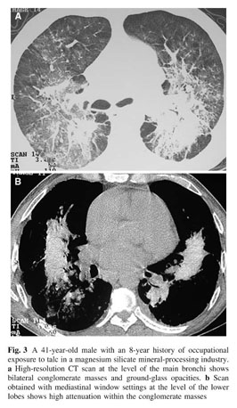 Pulmonary Talc Granulomatosis in a Cocaine Sniffer - ScienceDirect