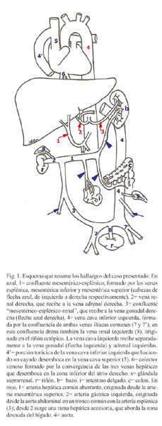 Congenital Absence of The Hepatic Portal Vein Associated to Intestinal ...