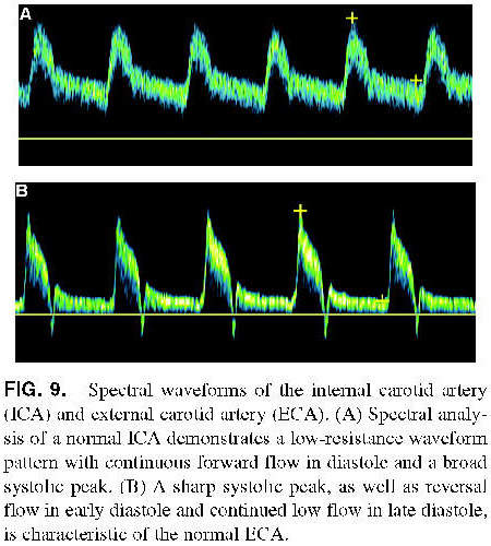 Gale Academic Onefile Document Arterial Vascular Hemodynamics