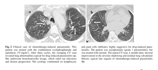 Pneumonitis and pulmonary fibrosis associated with breast cancer