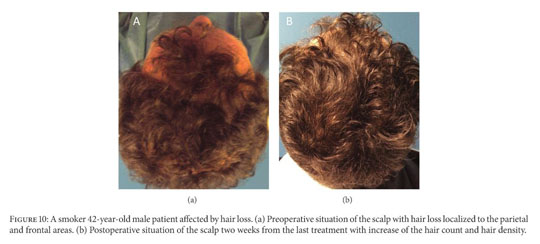 The effect of autologous activated platelet rich plasma (AA-PRP) injection  on pattern hair loss: clinical and histomorphometric evaluation - Document  - Gale Academic OneFile