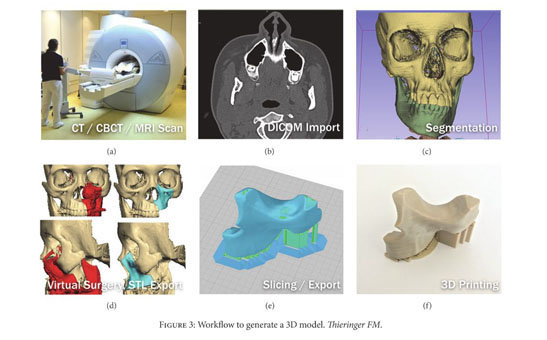 Gale Onefile Health And Medicine Document Patient Specific Surgical Implants Made Of 3d Printed Peek Material Technology And Scope Of Surgical Application