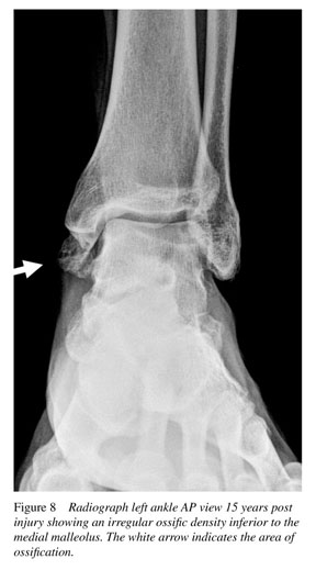 deltoid ligament of the ankle