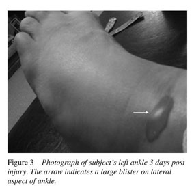 Acute compartment syndrome of the foot in a soccer player: a case report -  Document - Gale Academic OneFile