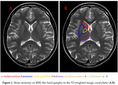 Neuroimaging of Basal Ganglia in Neurometabolic Diseases in