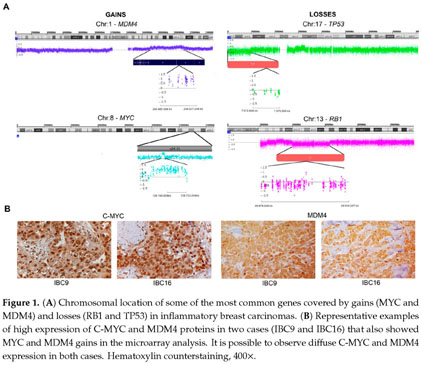 Inflammatory Breast Cancer Clinical Implications Of Genomic Alterations And Mutational Profiling Document Gale Academic Onefile