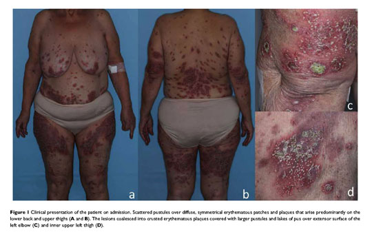 Clinical picture of Case 1 showing an erythematous, mildly crusted