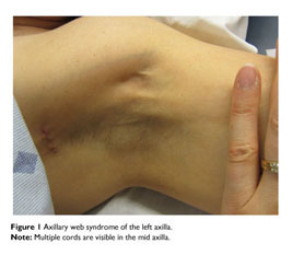 AXILLARY WEB SYNDROME (AWS) “CORDING”: WHAT IS IT?