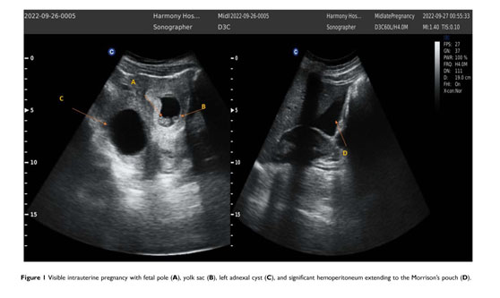 A unique case of diagnosis of a heterotopic pregnancy at 26 weeks