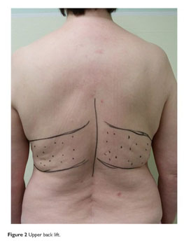 SC-31 Stage 1 High Back Abdominoplasty Girdle