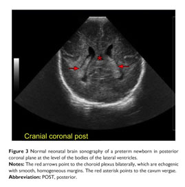 normal neonatal head ultrasound