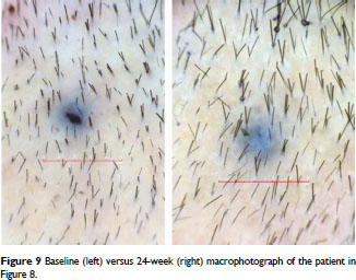 Hair follicle growth by stromal vascular fraction-enhanced adipose  transplantation in baldness - Document - Gale Academic OneFile