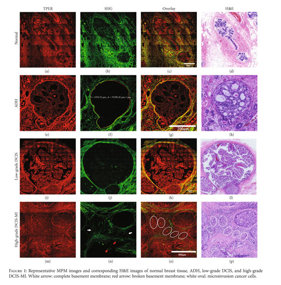 Label-Free Identification of Early Stages of Breast Ductal 