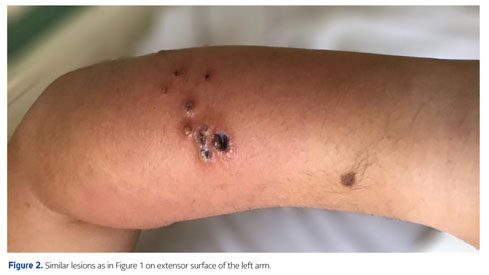 Axillary manifestations of dermatologic diseases: a focused review -  Document - Gale Academic OneFile