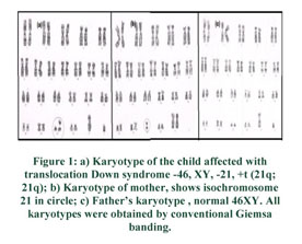 down syndrome karyotype translocation